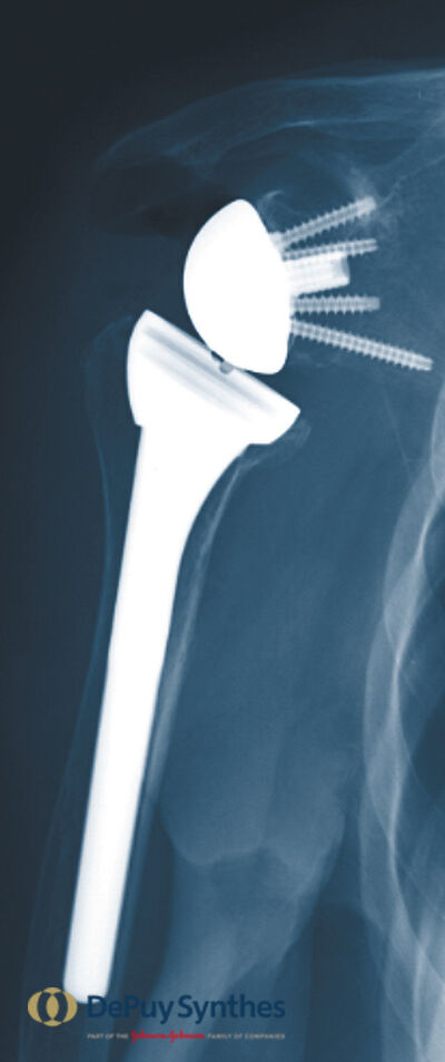 20150828-GB1009ESPIB-Patienteninfo_Schulter_2015-98-Postop-X-Ray